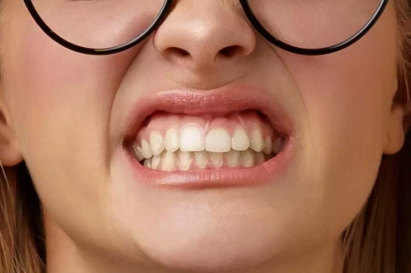 咬合力注意事項