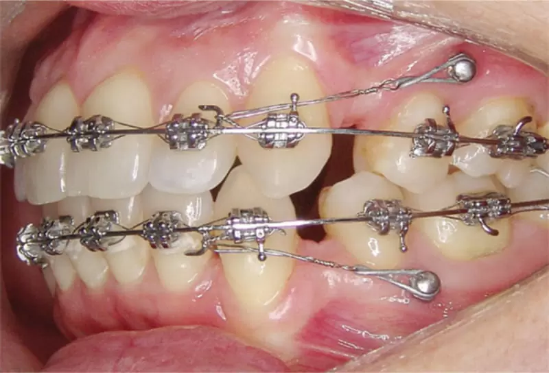 矯正骨釘術後注意事項