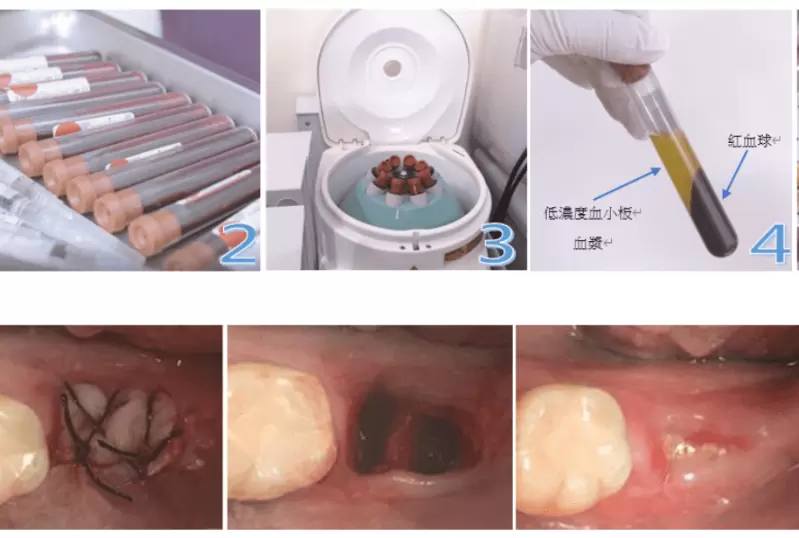 人體的修復功臣_PRF豐富血小板凝血因子膠原蛋白