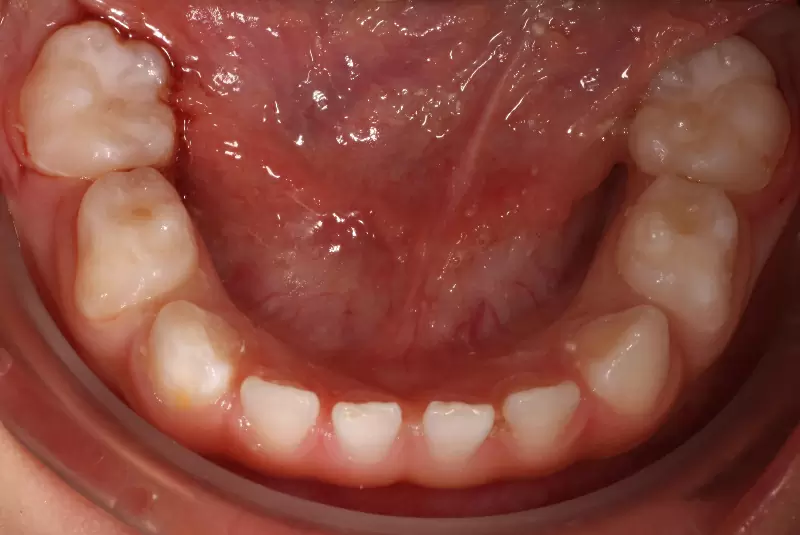 窩溝封填施作後須知