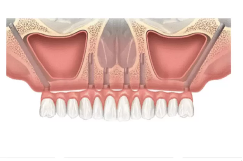All on 6 新式植牙術後注意事項