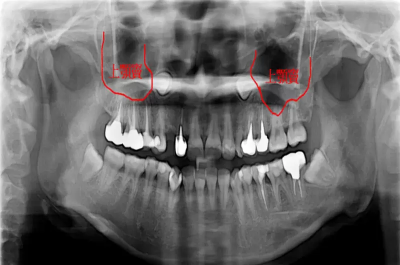 上顎鼻竇增高術（SINUS LIFT）