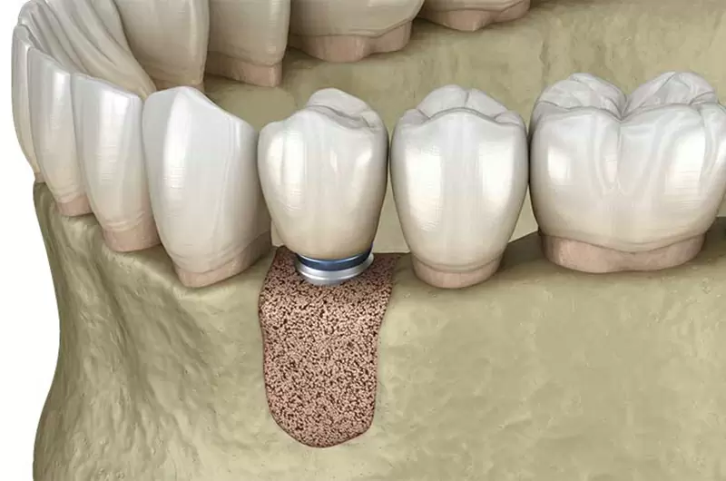 補骨後注意事項