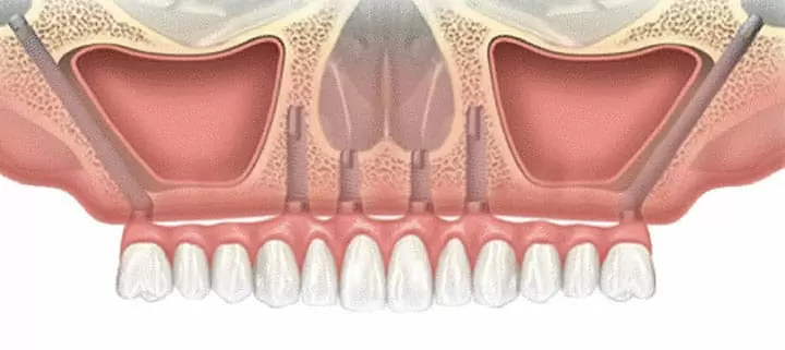 能承受更高的咬合力更適合亞洲人