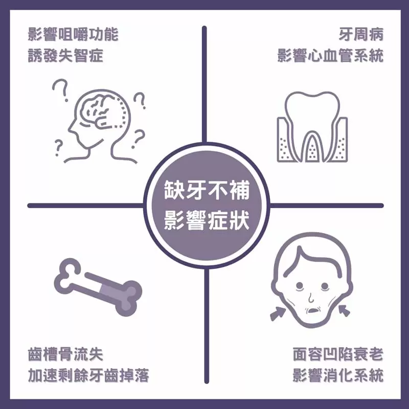 人工植牙 人工植牙