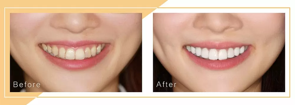 美容牙科 美容牙科