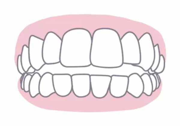 雙效隱形矯正 雙效隱形矯正